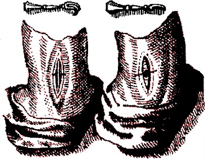 Hooks for Holding Skin, Scultetus